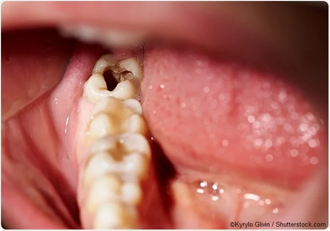 Tooth decay 680x Kyrylo Glivin
